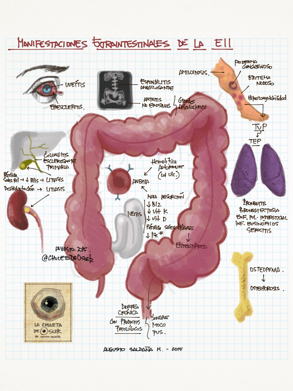 EII_-_complicaciones