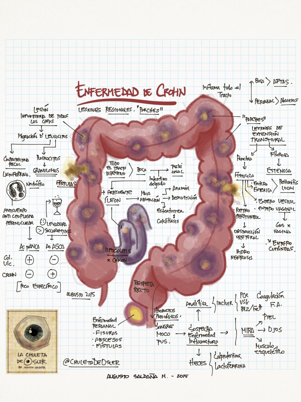 EII_-_enfermedad_de_Crohn
